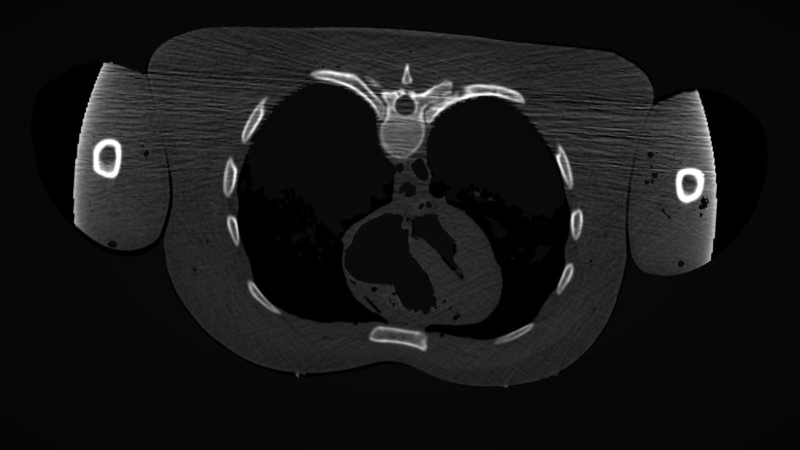 A CT slice